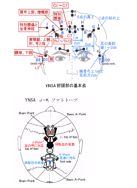 山元式新頭針療法YNSA